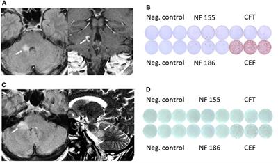 Neurofascin (NF)155- and NF186-Specific T Cell Response in a Patient Developing a Central Pontocerebellar Demyelination after 10 Years of CIDP